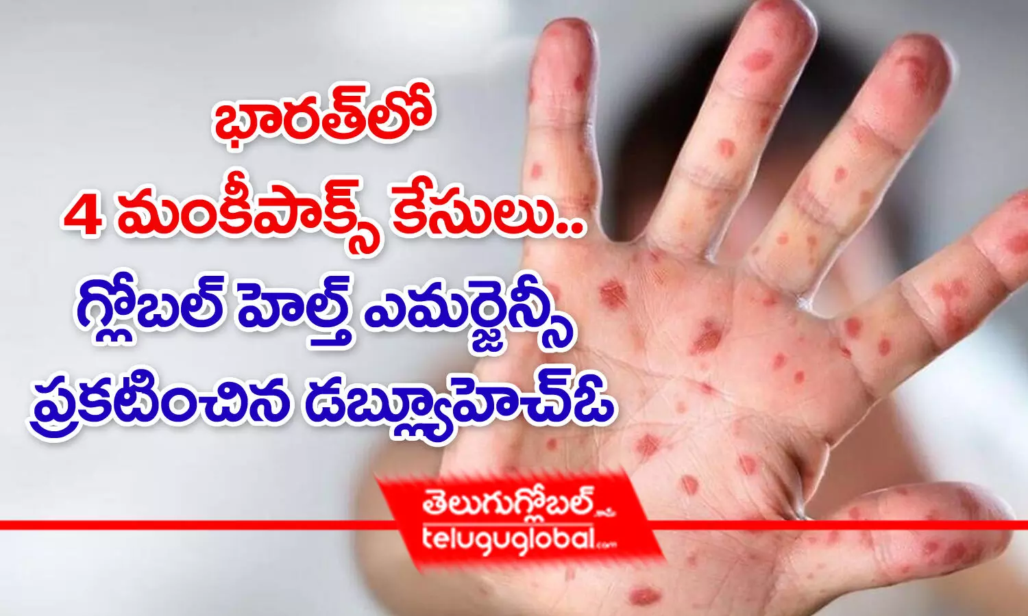 Monkeypox cases in india