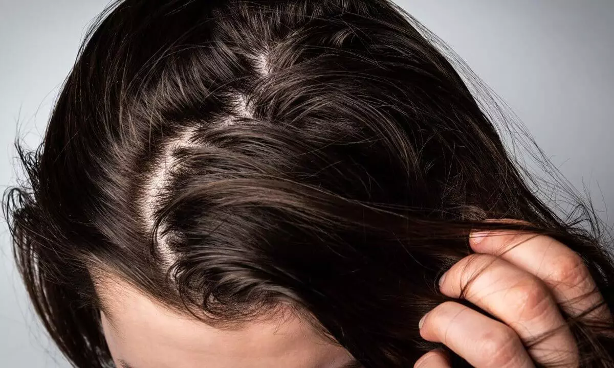 జుట్టు జిడ్డుగా మారుతోందా? | Hair Tips in Telugu: How to get rid of greasy  hair