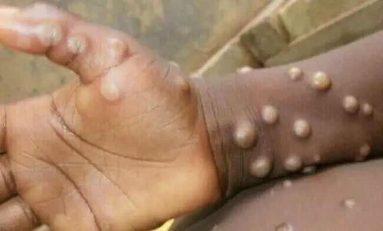 monkeypox cases in Telangana